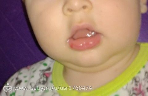Припухает нижняя губа Припухает нижняя губа