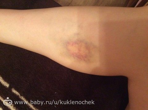 Чем намазать синяк в домашних условиях 745