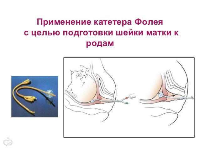 Подготовка шейки матки в домашних условиях Подготовка шейки матки в домашних условиях