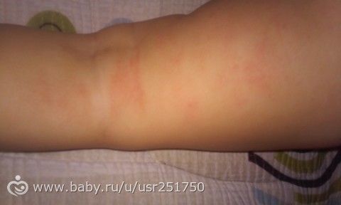 Сыпь. Нужен взгляд со стороны. Фото