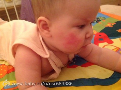 первый раз аллергия у малышки
