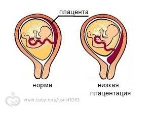 Низкое расположение плаценты при беременности