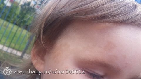 Пигментация на лице