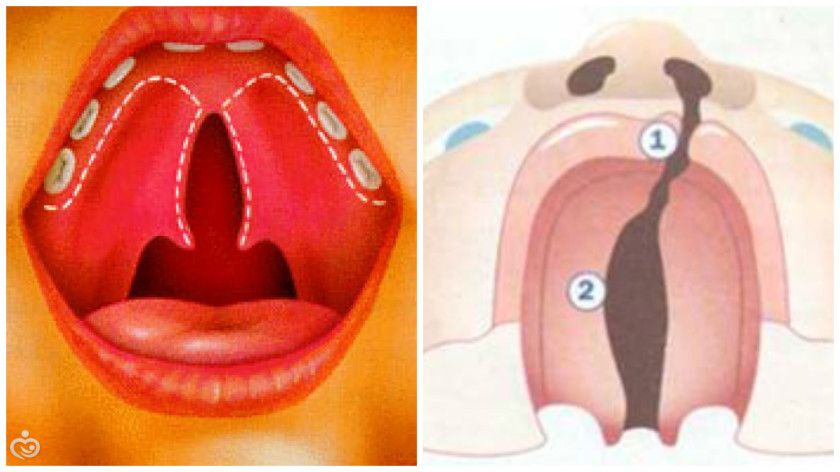 Заячья губа и Волчья пасть. Причины развития и лечение