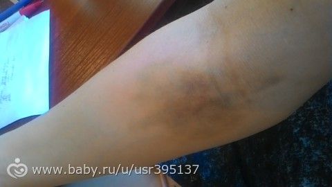 Курение и варикозное расширение вен