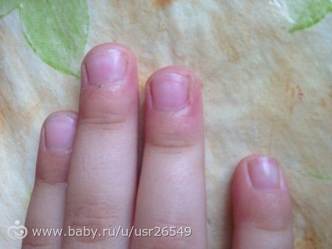SOS.Ребенок поранился.Что делать?