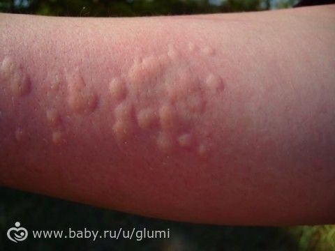 Аллергия у ребенка - что делать?