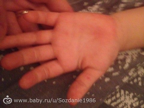 инфекционный моноуклеоз !!??