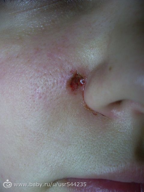 Кому убирали родинки, электрокоагуляцией (электронож) это так бывает? Слабонервным не смотреть.