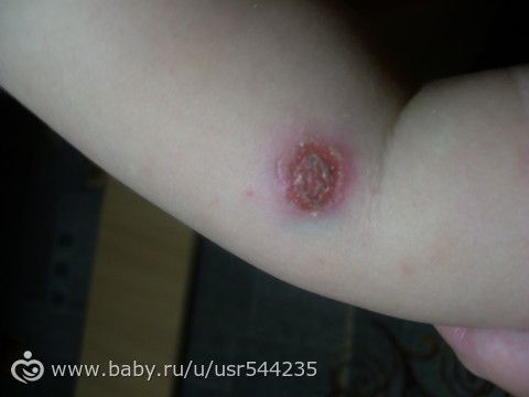 сначала выглядело как укус комара....