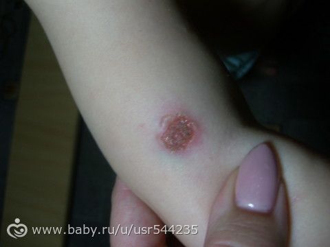 сначала выглядело как укус комара....