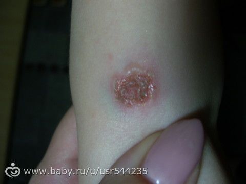 сначала выглядело как укус комара....