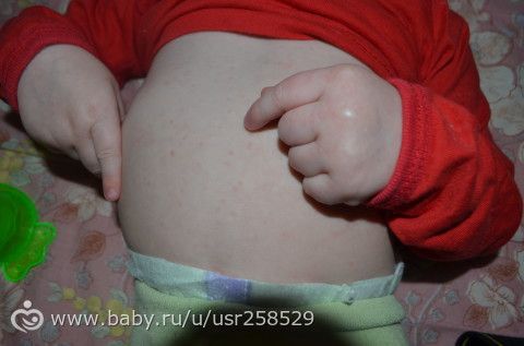 пятнышки на теле у ребенка,аллергия или нет не пойму
