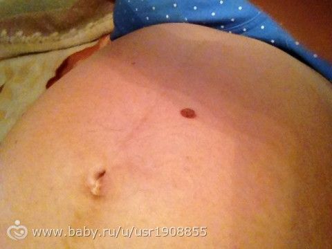 Родинки и другие напасти на коже...