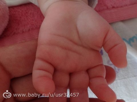 На двух ладонях линия Симиана (обезьянья линия)