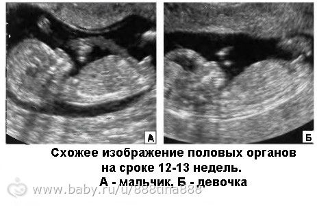 11 Недель Беременности Пол Ребенка Фото