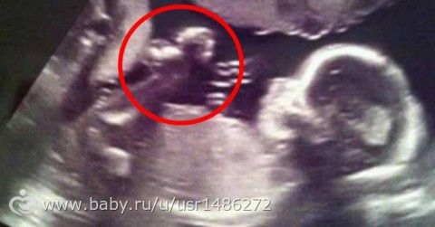 снимок узи ребенка и ангела рядом..вы его видите?)