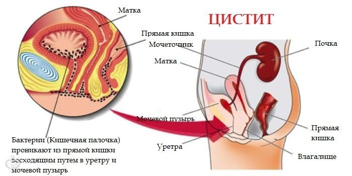 Применение трав при лечении цистита.