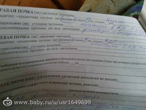 Я в шоке, у меня оказывается камни! (фото)