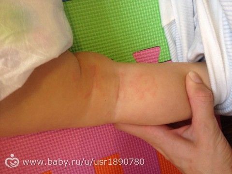 Аллергия под коленкой!